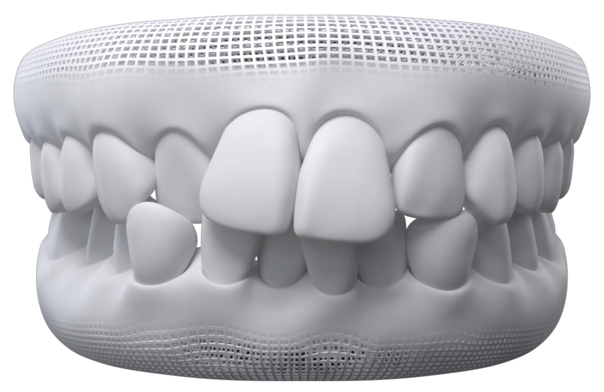 graphic of crowded teeth